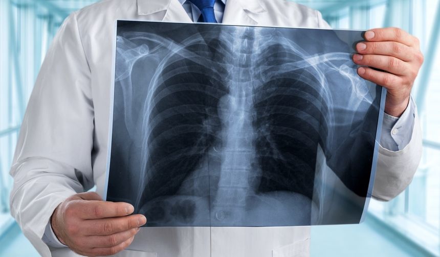 Tüberkülozdan her yıl bir milyon kişi ölüyor!