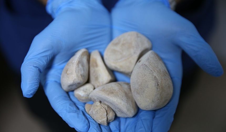 İdrar kanalı ve mesanesinden yarım kilo taş çıkarıldı!