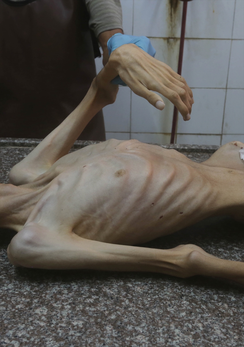 Gazze'de Yetersiz Beslenme Nedeniyle 17 Yaşındaki İsmail Hayatını Kaybetti 3