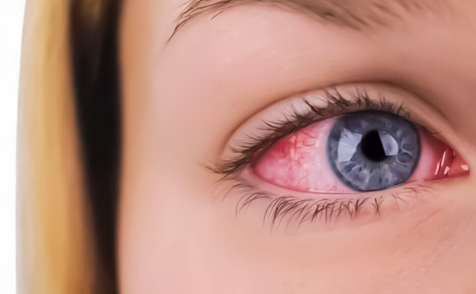 Glokom Goz Tansiyonu 01