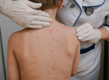 Kizamik Nedir B O Vlzd