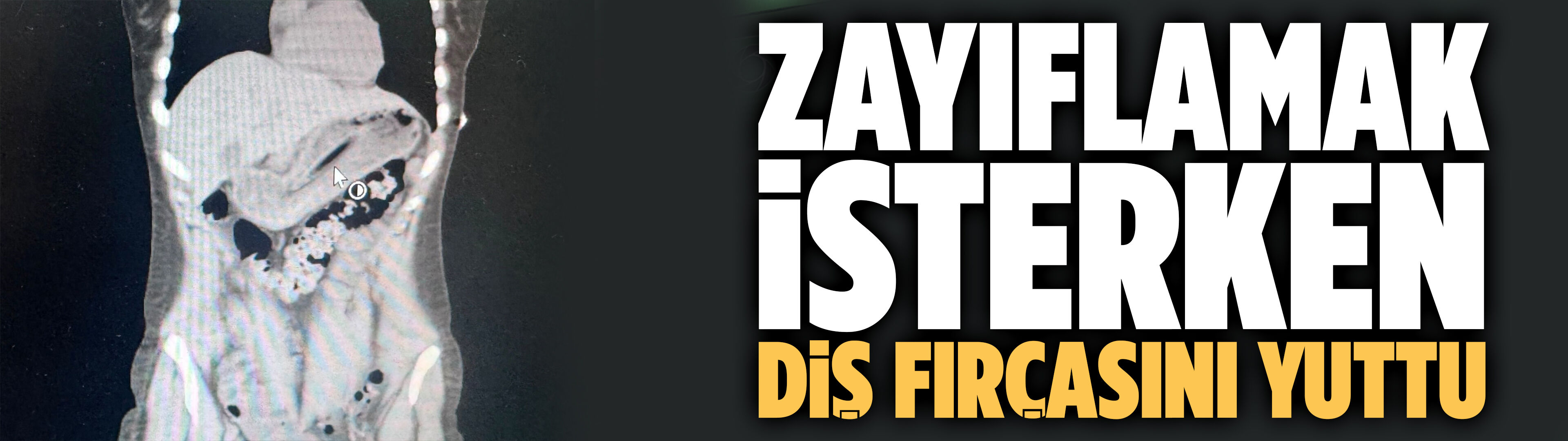 Zayıflamak isterken diş fırçasını yuttu